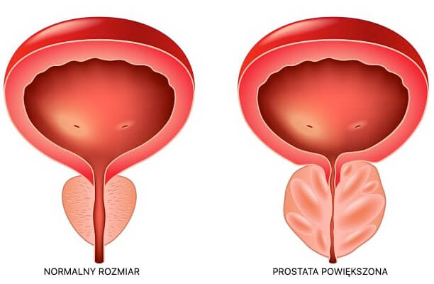 co na prostatę simptome de prostata